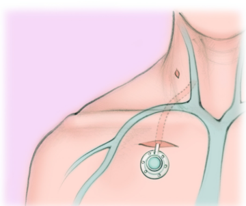 chemo port insertion