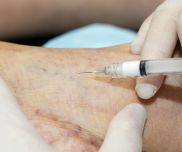 varicose vein injection