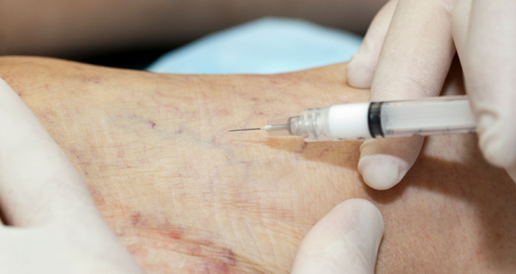 varicose vein injection